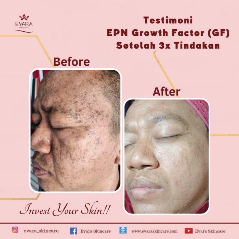 Bopeng adalah bekas jerawat yang berbentuk cekung seperti lubang atau lekukan pada kulit.