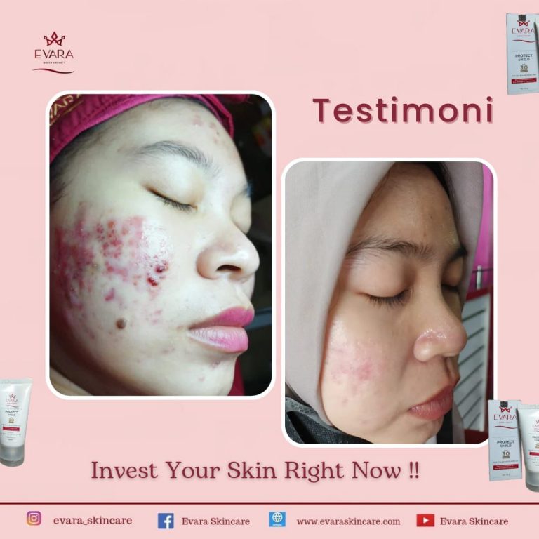 Evarapedia Bab PIE Post-inflammatory erythema (PIE) adalah kondisi kulit yang ditandai dengan kemerahan atau perubahan warna lainnya setelah terjadi peradangan.