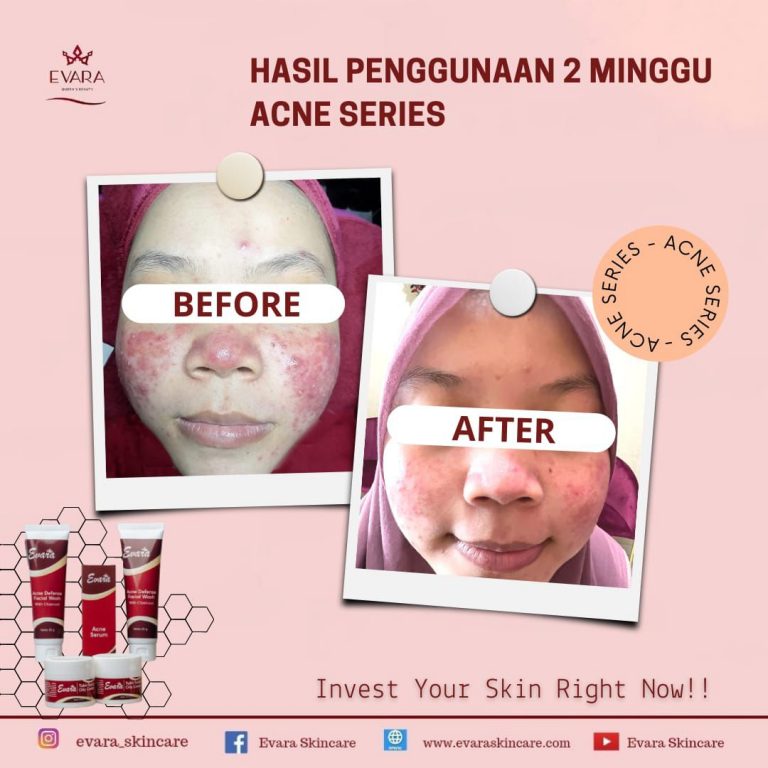 Acne rosacea atau rosacea adalah penyakit kulit kronis yang menyebabkan kemerahan, jerawat, dan pembuluh darah wajah terlihat jelas.