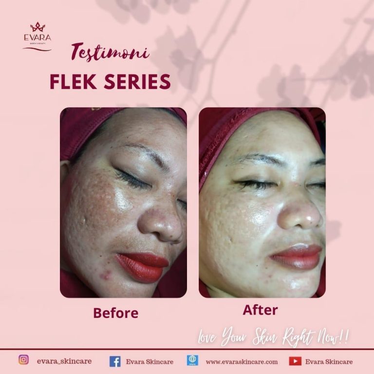 Melasma adalah kelainan kulit yang ditandai dengan munculnya bercak-bercak cokelat pada wajah.